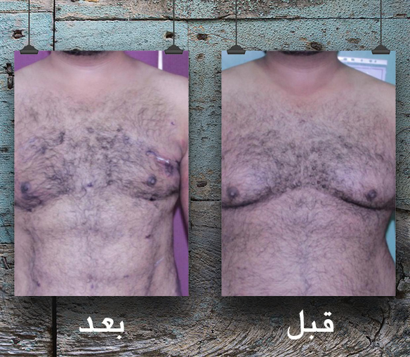شفط الدهون بالفيزر